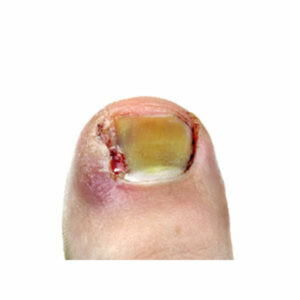 ingrowing toenail